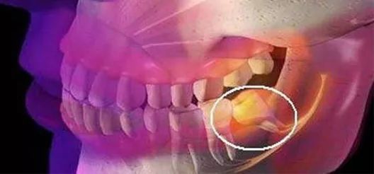 牙齦紅腫、牙齦出血？要警惕這4種牙齦疾病！