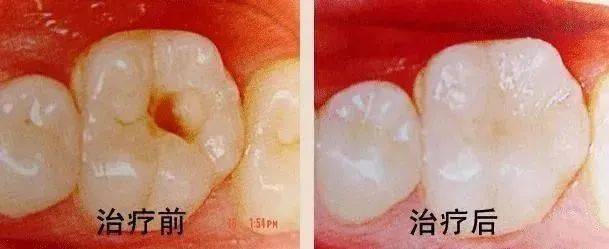 去補(bǔ)牙，怎么醫(yī)生倒把牙洞越磨越大了？ 