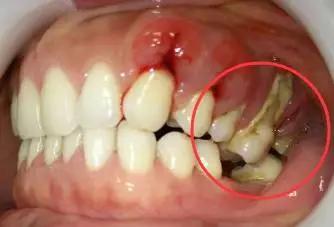 牙縫變大、牙齒松動(dòng)、牙齒變敏感是不是牙被洗壞了?