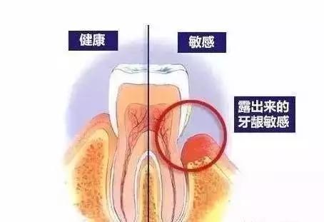牙縫變大、牙齒松動(dòng)、牙齒變敏感是不是牙被洗壞了?