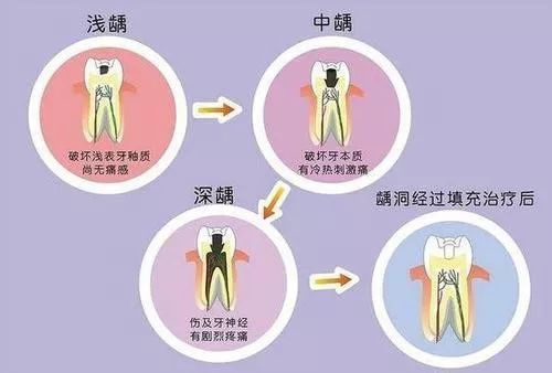 你的牙齒健康嗎？牙齒早衰的六大信號(hào)要記牢