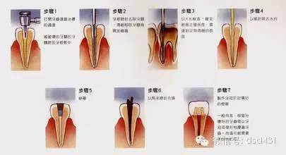 牙科-根管滲血處理法 