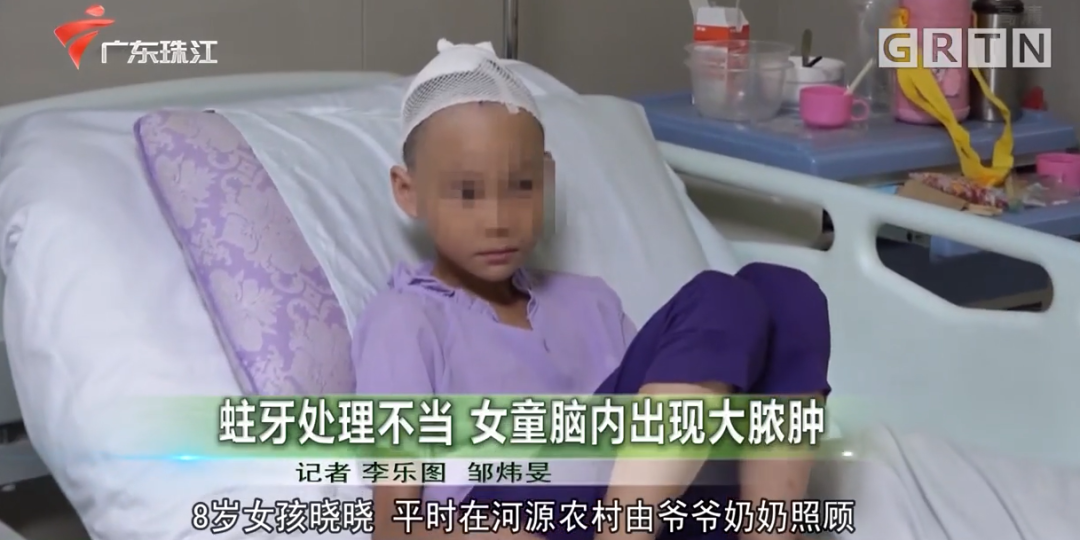牙病處理不可輕視！8歲女童蛀牙致腦內(nèi)長(zhǎng)膿腫