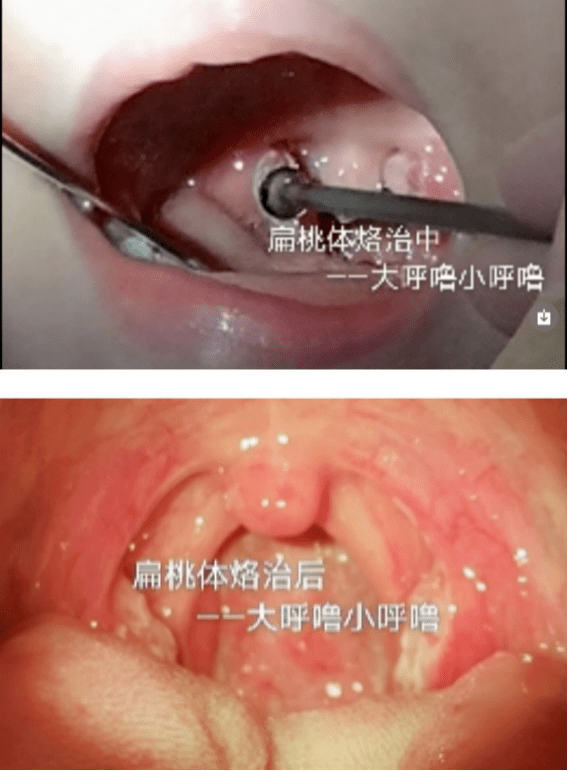 矯正牙齒前竟然要先看耳鼻喉科？ 