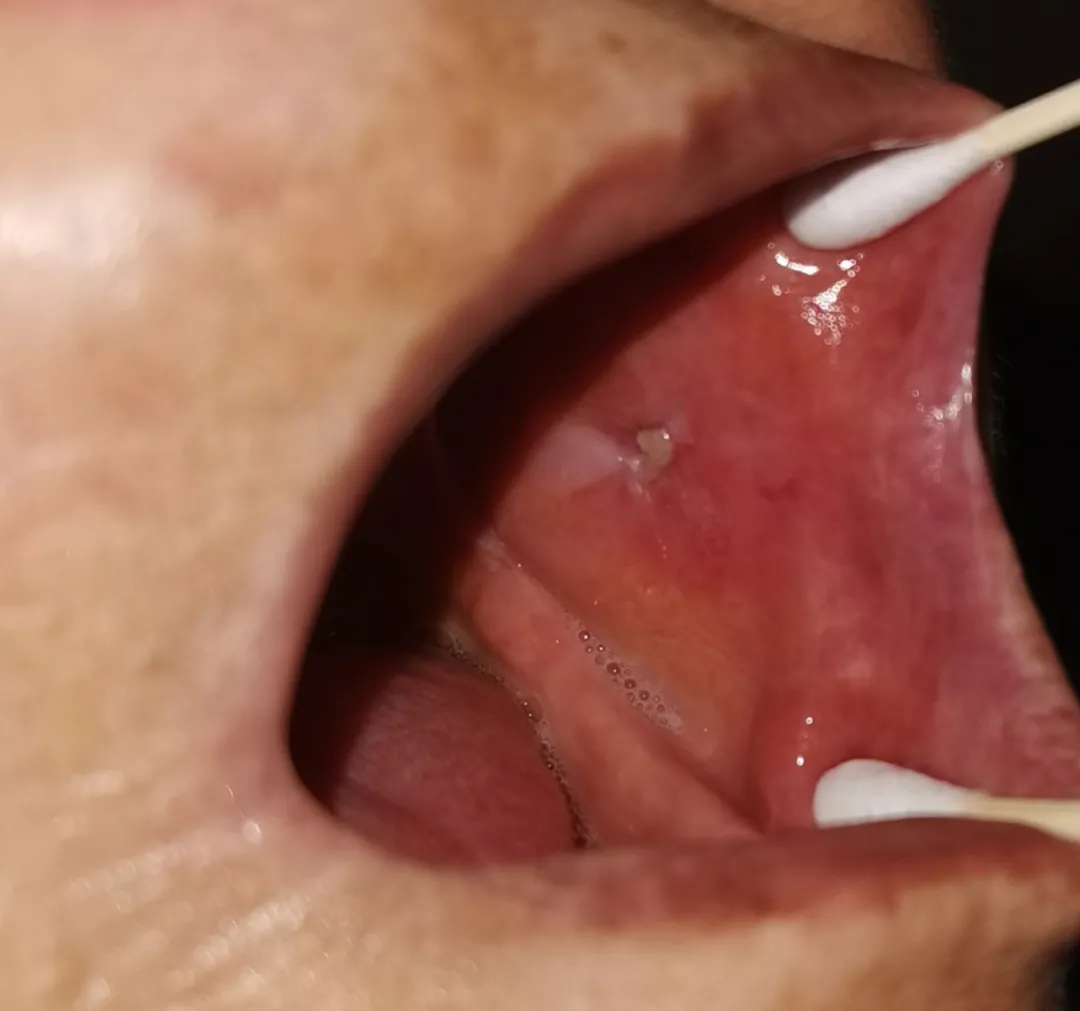 口腔潰瘍竟是癌！原是假牙惹禍