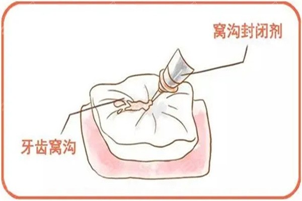 窩溝封閉