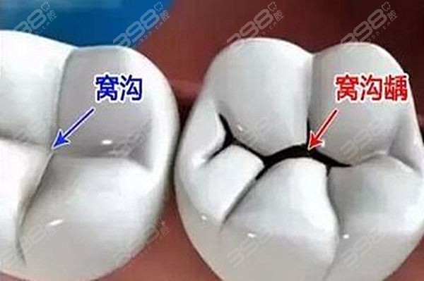 窩溝齲