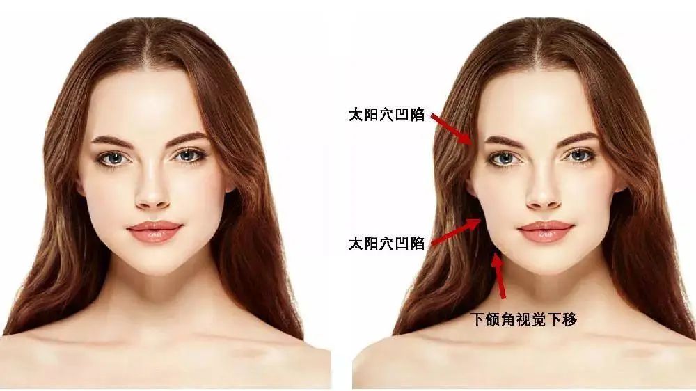 正畸如何預(yù)防牙套臉及法令紋