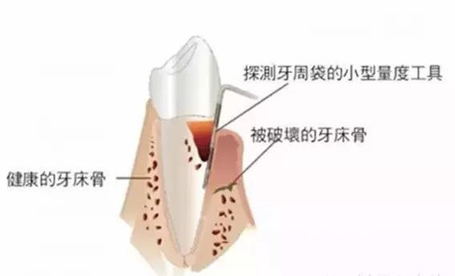 牙齒種植需要哪些條件