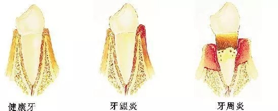 牙齦天天在萎縮！牙齦萎縮了該怎么辦？