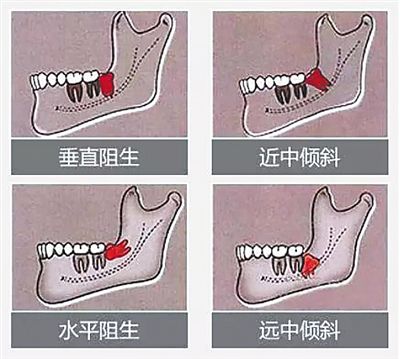 四類智齒請(qǐng)及時(shí)拔除