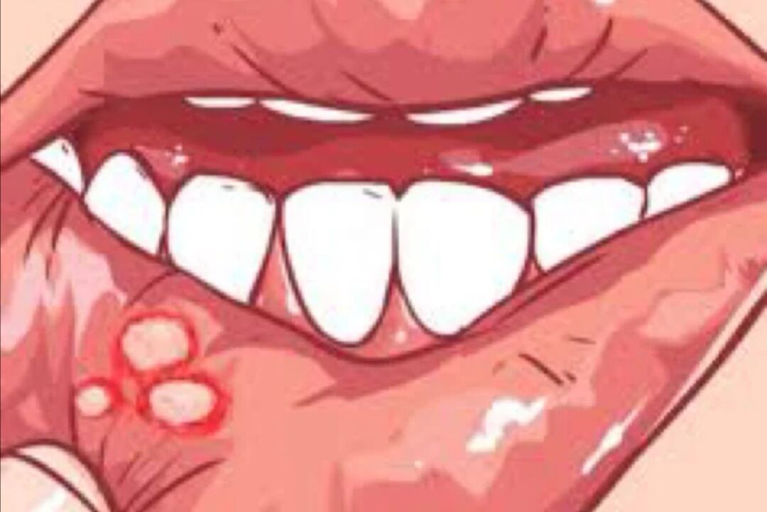 口腔潰瘍就是缺維生素?謠言~更多是這4個原因