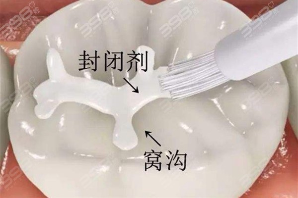 給孩子的牙齒穿上 “保護(hù)衣”：窩溝封閉的重要性不要忽視哦~