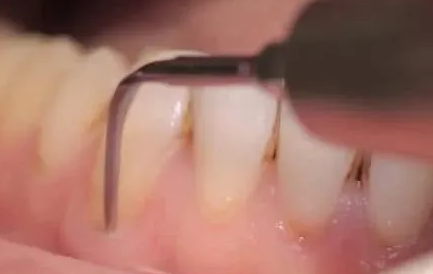 口腔常見小問題和自我處理方法！