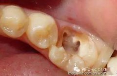 牙科-根管滲血處理法
