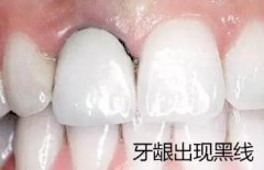 烤瓷牙變這樣必須拆掉