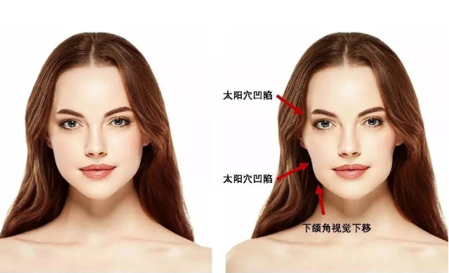 正畸如何預防牙套臉及法令紋