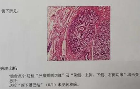 牙齦長“肉蛋”竟然是癌,專家提醒這個現(xiàn)象一定早診治