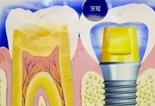 牙齒種植需要哪些條件
